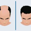 How to Make the Right Decision About A Hair Transplant